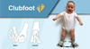 Clubfoot